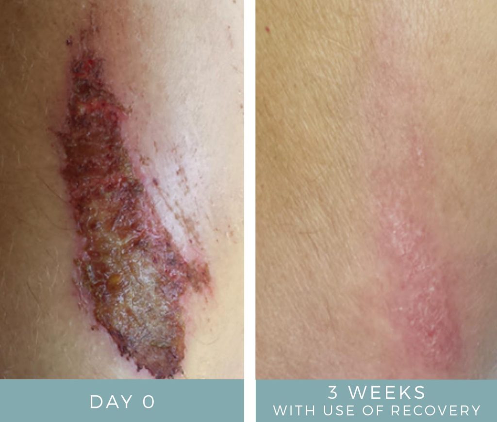 Before + After - Wound Care After Cycling Accident