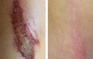 Before + After - Wound Care After Cycling Accident