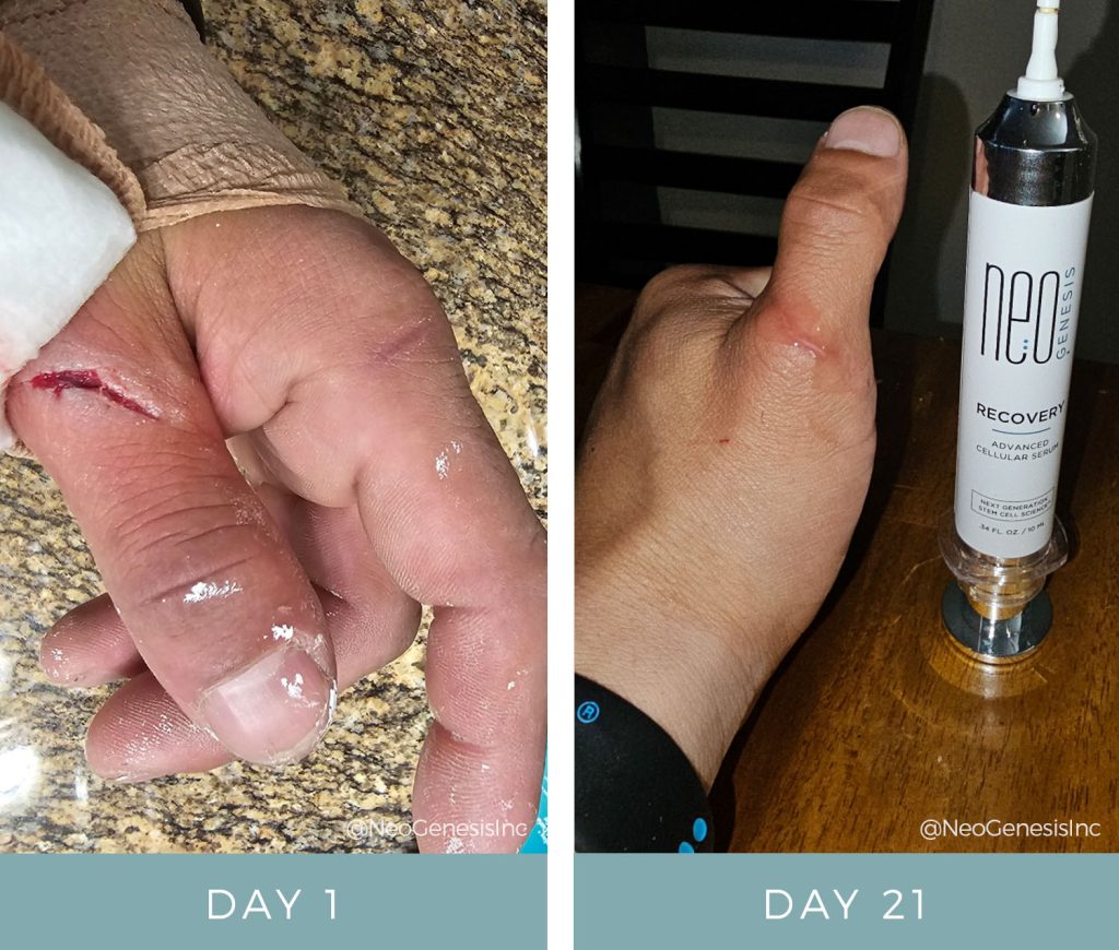 Before + After - Wound Care from Construction Accident