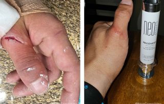 Before + After - Wound Care from Construction Accident