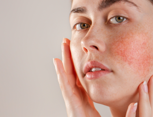 Managing Rosacea with Proper Skincare