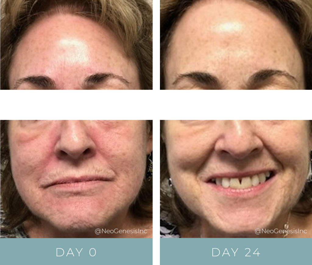 Before + After - Chemical Peel