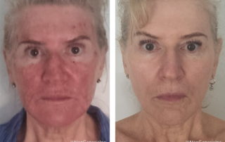 Before + After - Efudex Side Effects